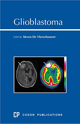 Large book cover: Glioblastoma